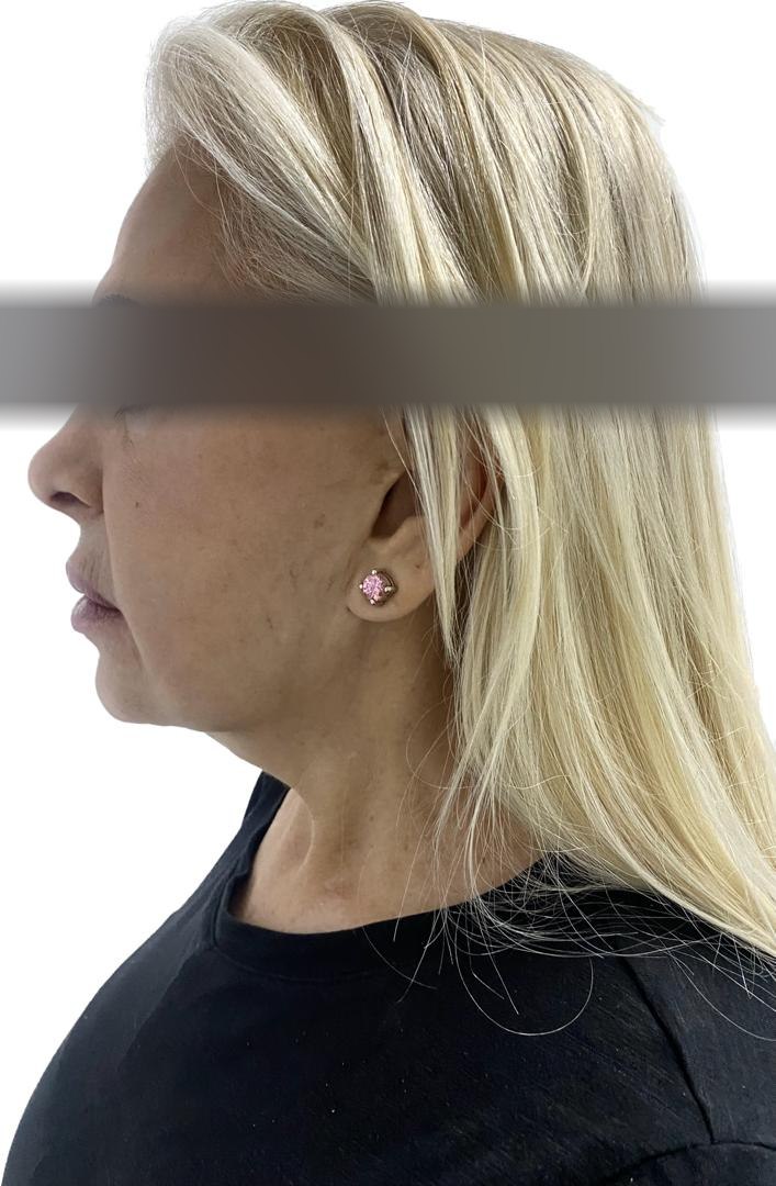 Cervicoplastia, antes