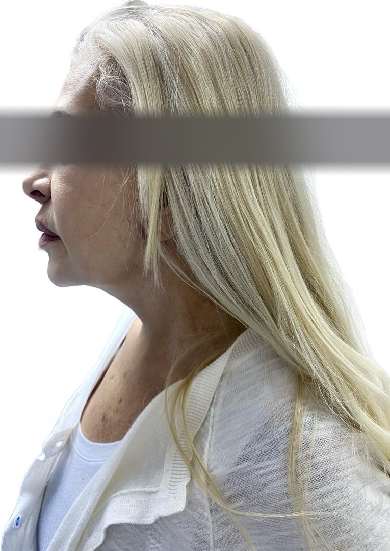 Cervicoplastia, después