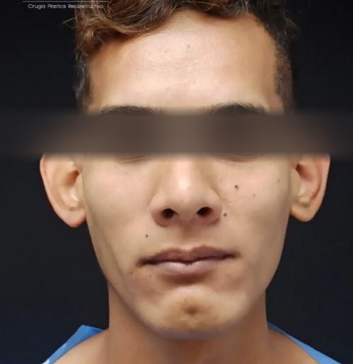 Otoplastia, antes