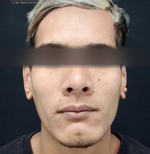 Otoplastia, después