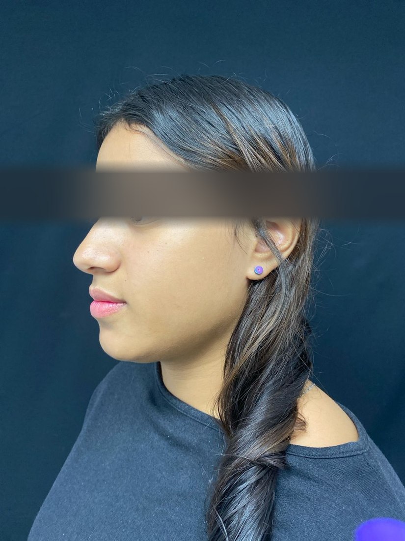 Rinoplastia abierta, antes