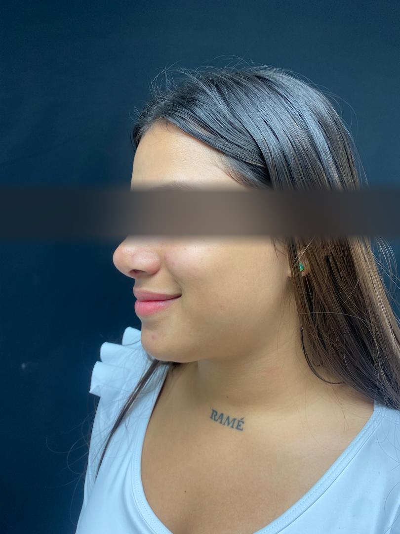 Rinoplastia abierta, después
